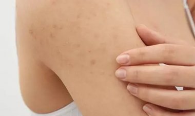 ত্বকে ছোট ছোট র‍্যাশ; ব্রণ নাকি কোনও রোগের লক্ষণ