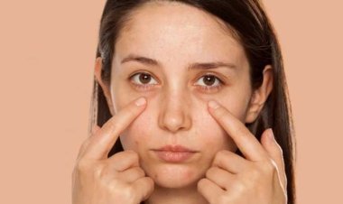 চোখের নিচের ফোলাভাব দূর করতে ঘরোয়া করণীয়