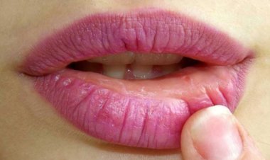 গরমকালে ঠোঁট ফাটলে মিলবে ৬ উপায়ে সমাধান!